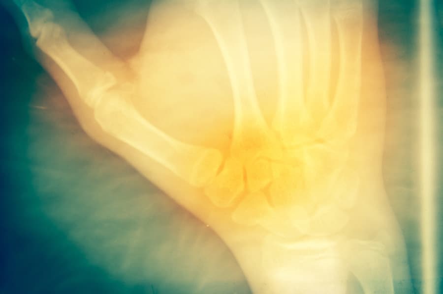 Tips For Dealing With Rheumatoid Arthritis as an Ostomate | by AJ Leveille
