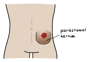 Parastomal hernia location diagram