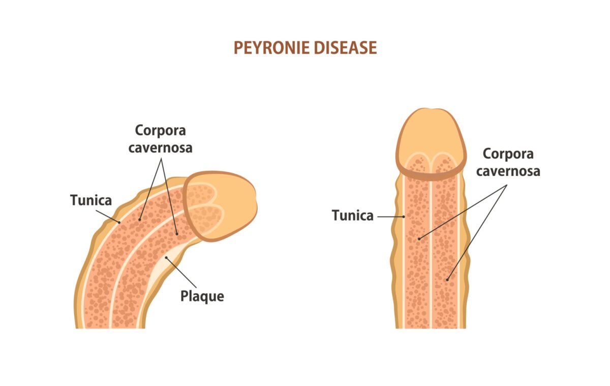 peyronie disease - Why Is My Penis Bending And How to Fix It